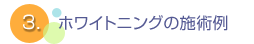 ホワイトニングの施術例